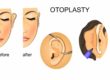 ear surgery otoplasty Providence, UT