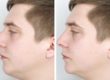 Is a Rhinoplasty Painful? | Cache Valley Facial Plastics | Providence, UT