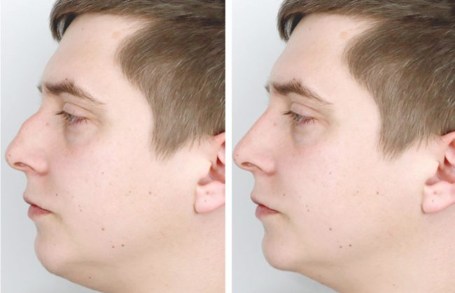 Is a Rhinoplasty Painful? | Cache Valley Facial Plastics | Providence, UT