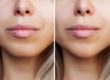 What is a Genioplasty | Cache Valley Facial Plastics | Providence, UT
