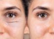 10 Eye-Opening Facts About Blepharoplasty | Cache Valley Facial Plastics | Providence, UT