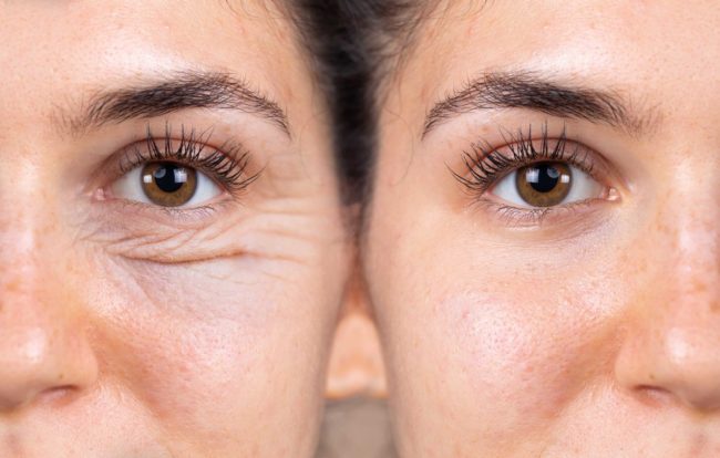 10 Eye-Opening Facts About Blepharoplasty | Cache Valley Facial Plastics | Providence, UT